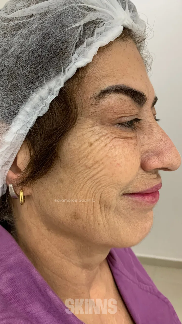 Antes — Skims Rejuvenescimento