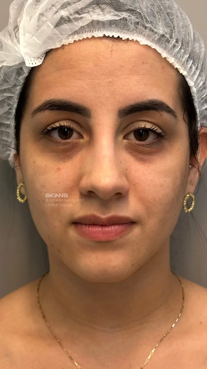 Antes — Blefaropeel