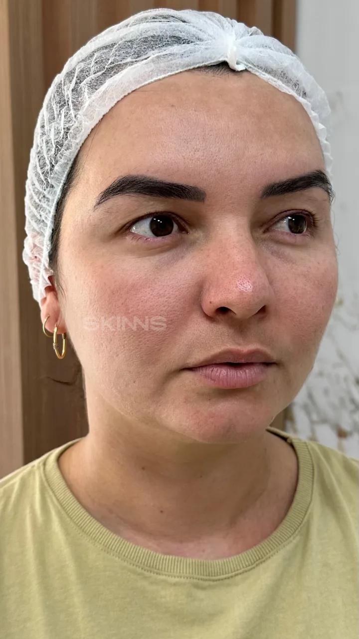 Depois — Skims Melani