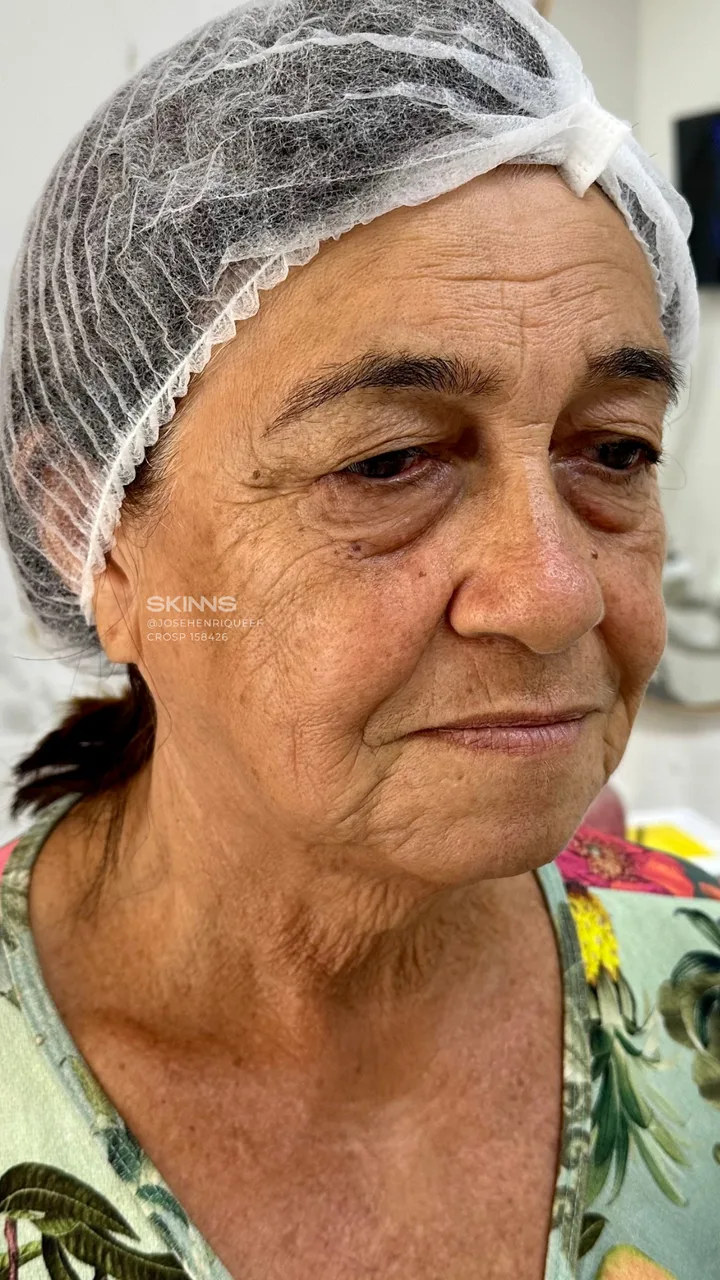 Antes — Skims Rejuvenescimento