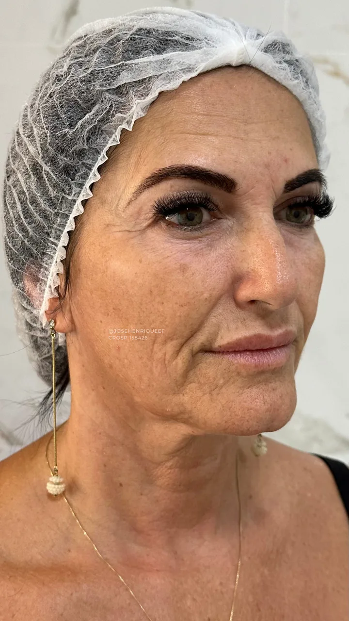 Antes — Skims Rejuvenescimento