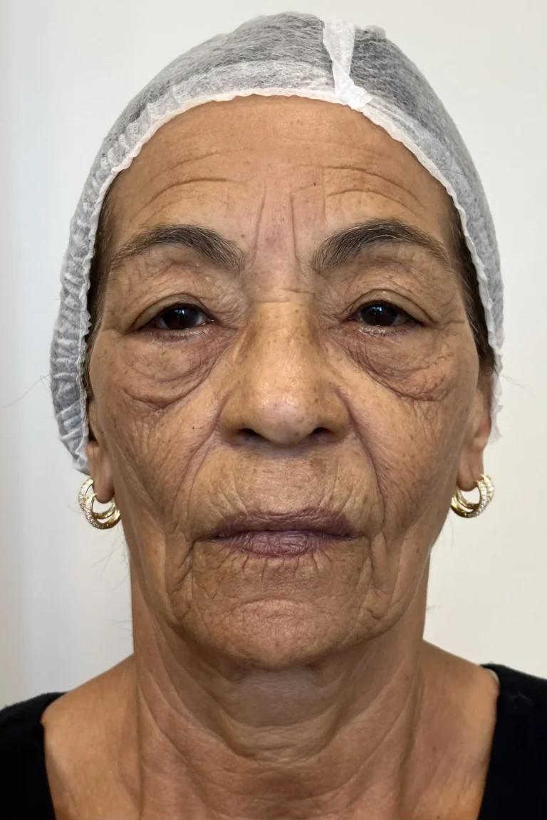 Antes — Peeling, paciente Eliete Mendes