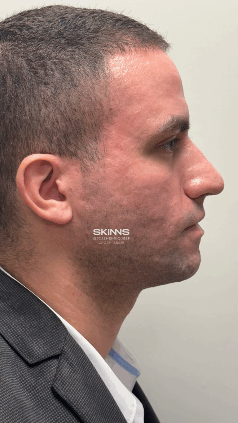 Depois — Peeling, paciente Ciro Gonçalves